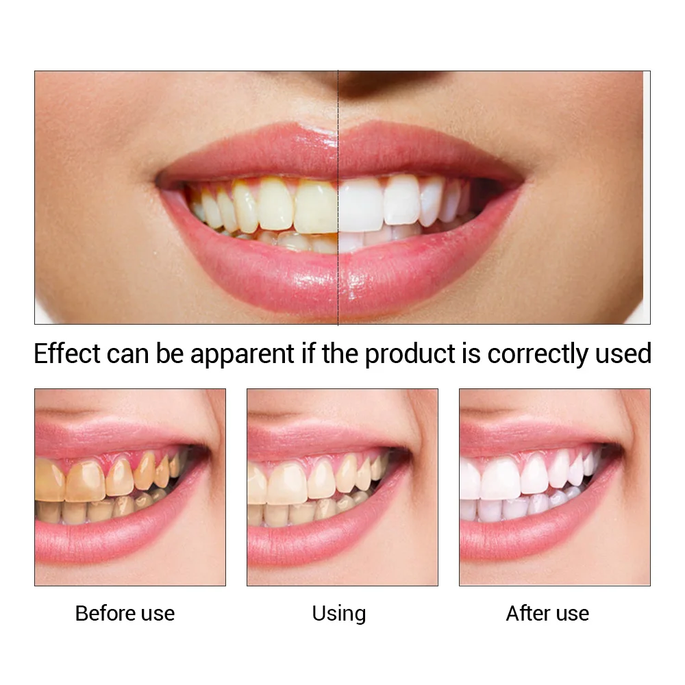 FTEENPLY Teeth Whitening Essen - Teeth Whitening Ulta 评论和价格