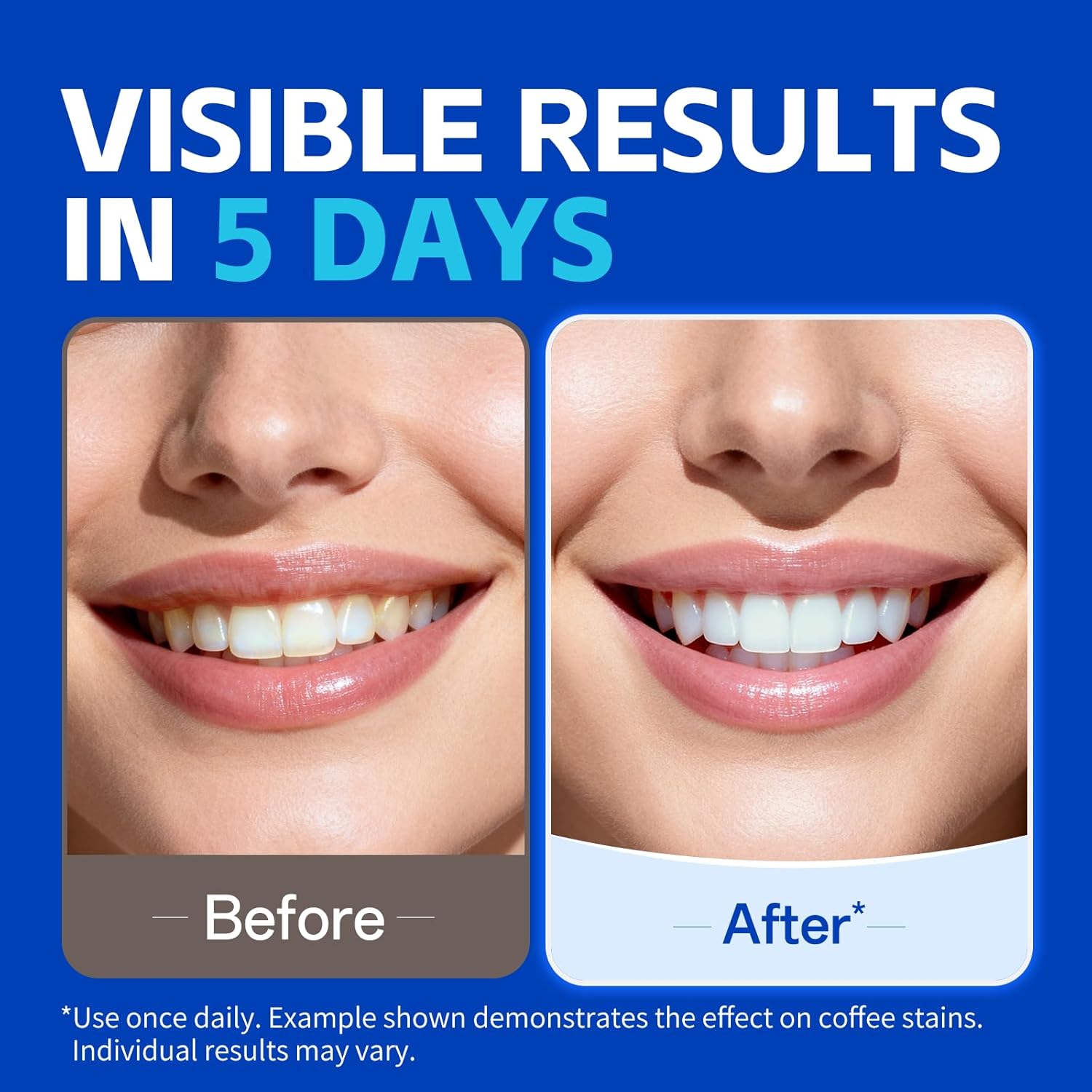 1/7 Pairs Teeth Whitening Stri - Teeth Whitening Street 评论和价格
