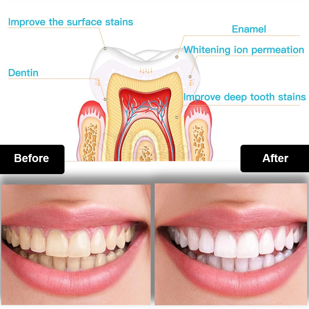 Dental Teeth Whitening Kit Min - Teeth Whitening Pens 评论和价格